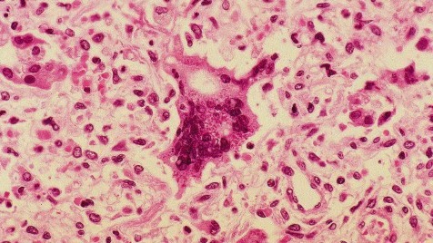 LA County investigates measles case
