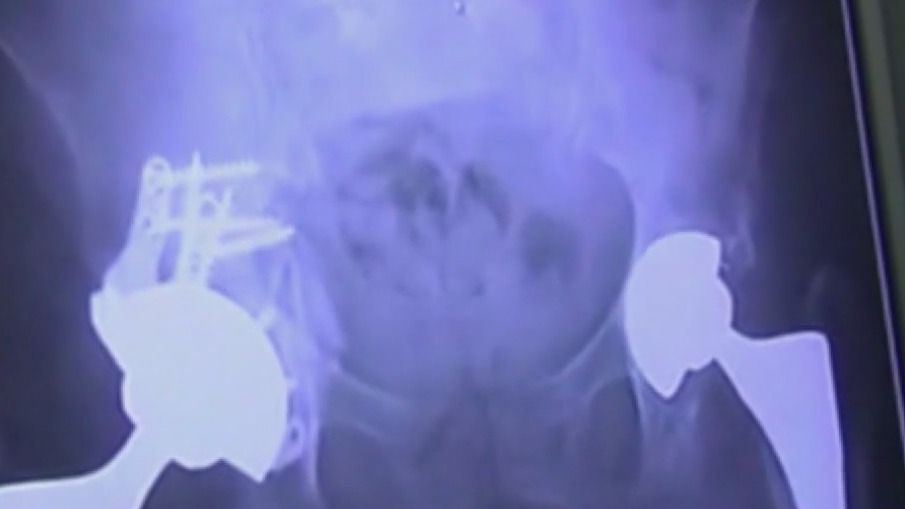 Warning signs for hip problems