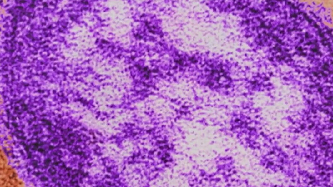 Concerns over US measles outbreaks