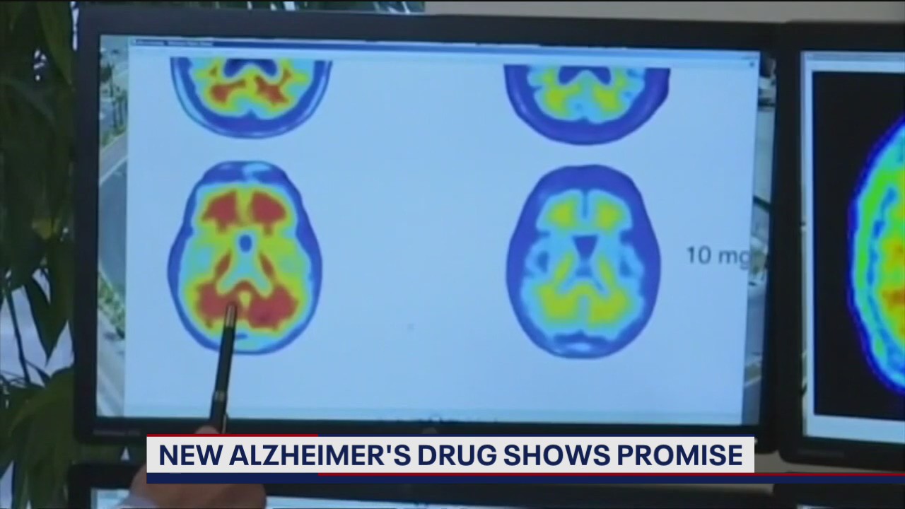 New Alzheimer's Drug Shows Promise