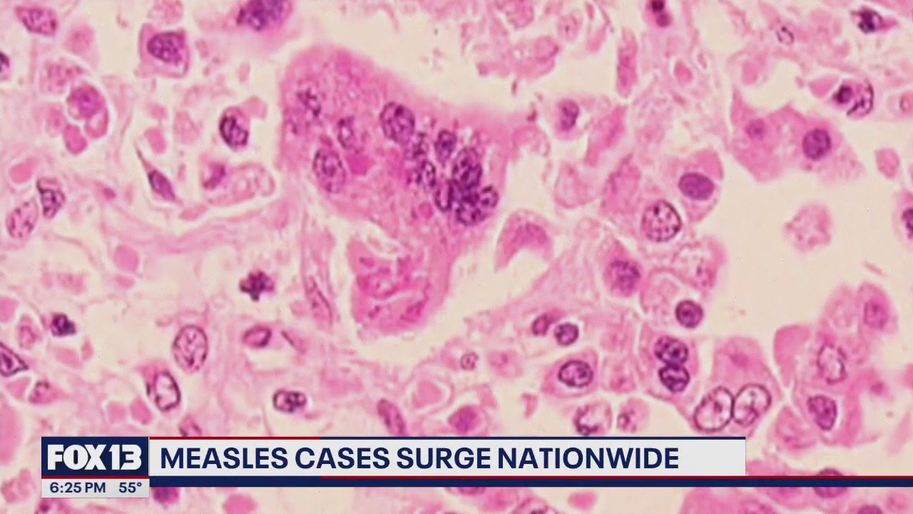 Push for vaccinations as measles cases surge