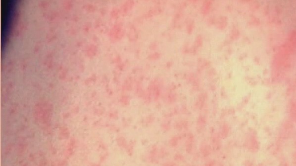 Measles outbreak: What you need to know