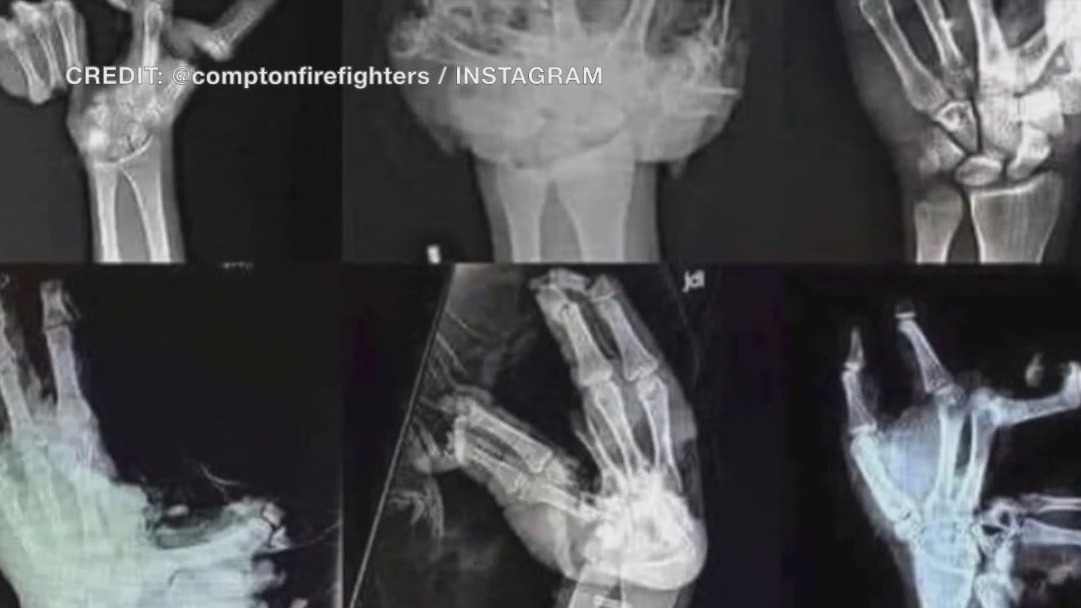 The dangers of fireworks