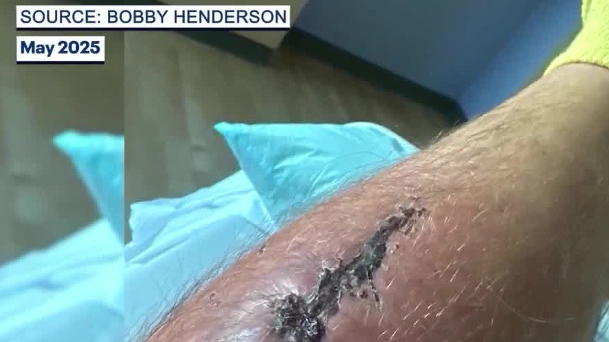 Flesh-eating bacteria warning in Florida