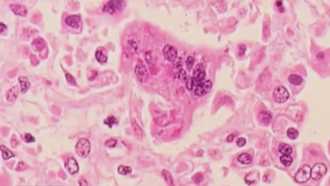 U.S. measles cases surge to highest