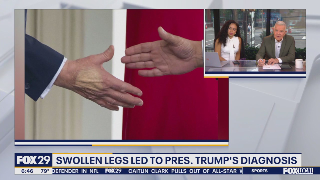 What is chronic venous insufficiency? President Trump diagnosed with common condition