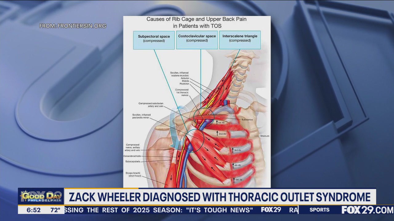 Dr. Mike breaks down Zach Wheeler's season-ending injury