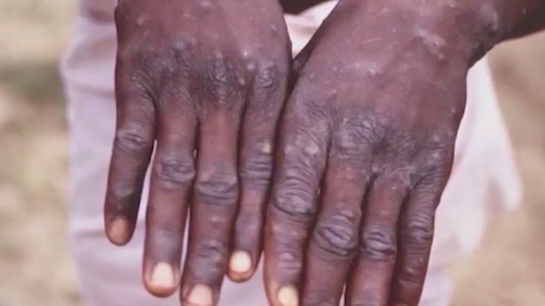 Mpox declared as a global health emergency